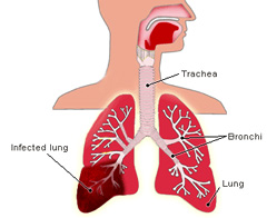 images of pneumonia